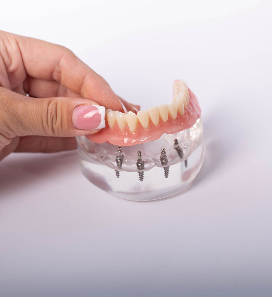 Protesi Dentali Overdenture